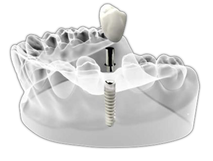 Illustration of a dental implant fixture implanted in a lower jawbone with the abutment and porcelain restoration hovering above