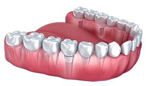 Illustration of lower arch with semi-transparent gums revealing a full set of teeth with few dental implants in the jawbone