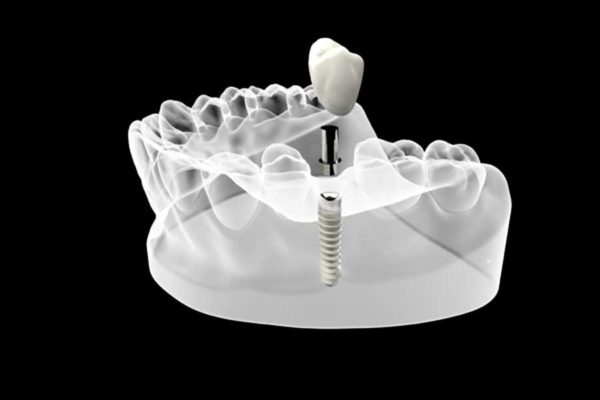 Partially transparent diagram of a lower jaw with dental implant fixture and the abutment and porcelain crown hovering above