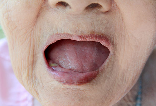 Elderly woman with missing teeth and mouth wide open to show her gums, thin lips are dry and wrinkled