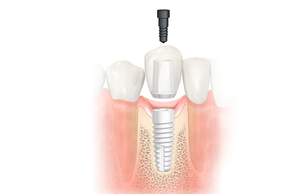 Dental implant installation graphic